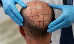 Saç Ekimi Hastalarının Deneyimleri
