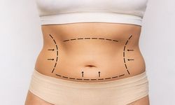 Liposuction ile Kolayca Fazla Yağlarınızdan Kurtulun