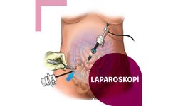 Laparoskopi Nedir