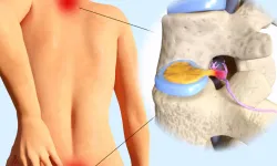 Ameliyatsız Bel Fıtığı ve Op. Dr. Murat Karakuş'un Bütüncül Tedavi Yaklaşımları