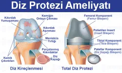 Diz Protezi Ameliyatı Hakkında Merak Ettikleriniz