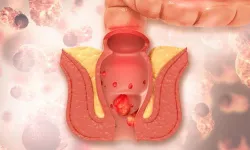 Hemoroid (Basur) Hakkında Merak Ettikleriniz: Utanmayı Bırakıp Sağlığınıza Odaklanmanın Zamanı