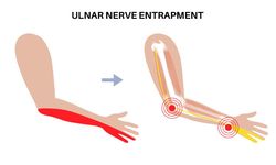 Ulnar Sinir Sıkışması: Elinizdeki Uyuşmanın Arkasındaki Sessiz Problem