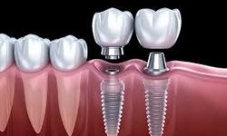İstanbul İmplant Tedavisi ile Ağız Sağlığında Kalıcı Çözümler