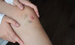 Kemik İliği Kanseri Nedir? Kemik İliği Kanseri Belirtileri Nelerdir?