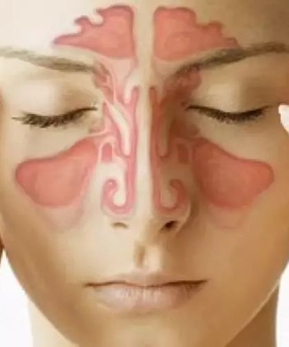 Sinüzit Nedir, Gerçekten Ciddi Bir Sorun mu?