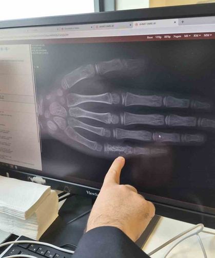 Eskişehir'de her ay 5 ila 7 çocuğa kanser tanısı konuluyor