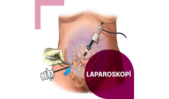 Laparoskopi Nedir