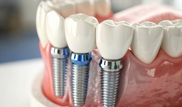 Gülüş Estetiğinde Kalıcı Çözümler Nasıl Sağlanır?