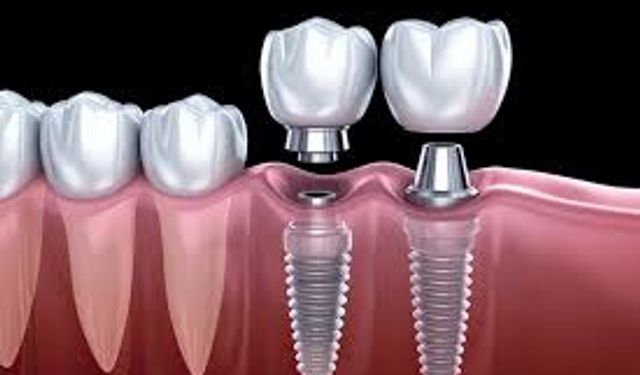 İstanbul İmplant Tedavisi ile Ağız Sağlığında Kalıcı Çözümler