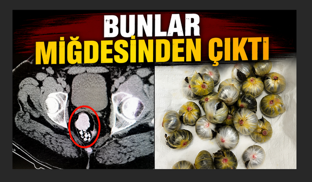 Midesinden uyuşturucu madde çıkan şahıs tutuklandı