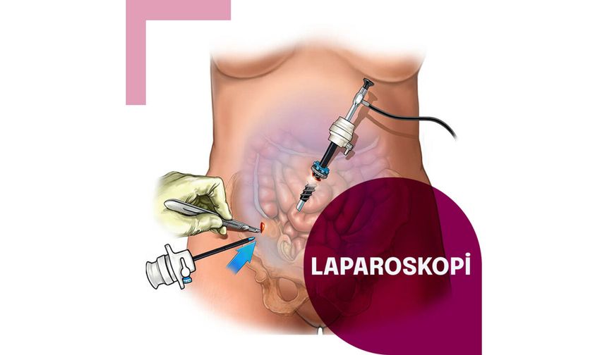 Laparoskopi Nedir