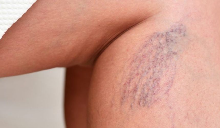 Bacak ağrısı yorgunluk değil, damar hastalığı işareti olabilir