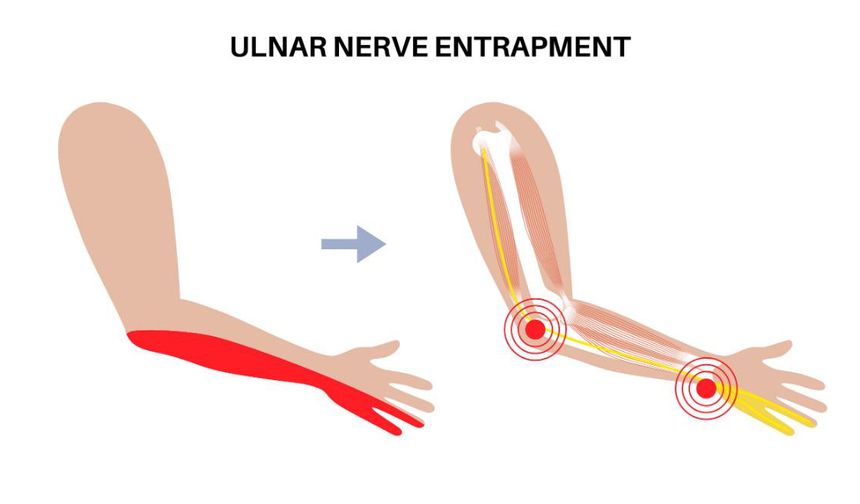 Ulnar Sinir Sıkışması: Elinizdeki Uyuşmanın Arkasındaki Sessiz Problem