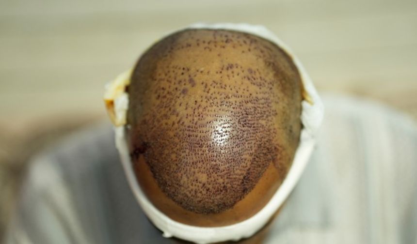 1000 Greft Saç Ekimi Fiyatları 2026: Yeni Dönem Ücretleri