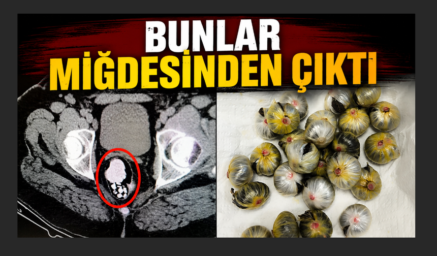 Midesinden uyuşturucu madde çıkan şahıs tutuklandı